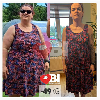 gastric sleeve turkey before and after