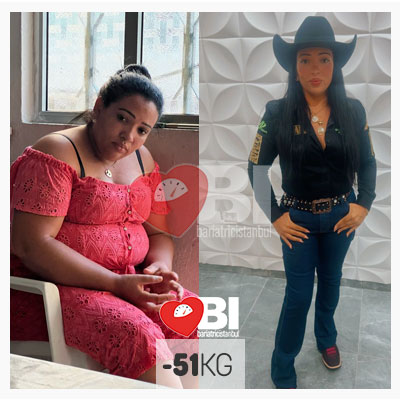 gastric sleeve turkey before and after