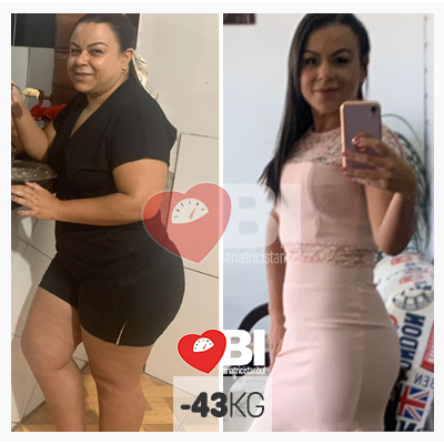 weightloss surgery turkey before and after